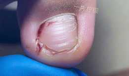 甲沟炎修脚视频,专业指导，轻松告别脚部困扰